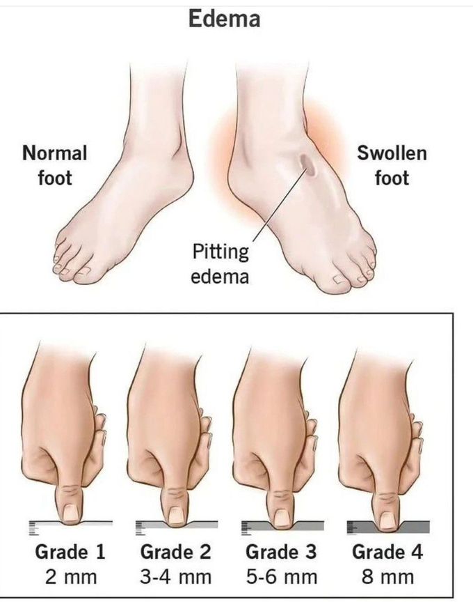 Edema