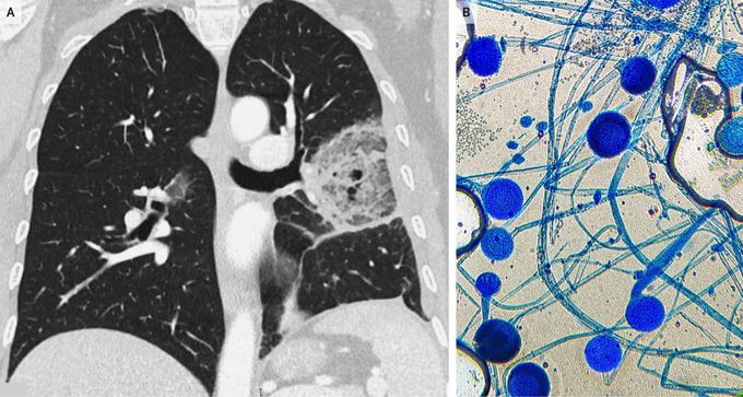 Pulmonary Mucormycosis