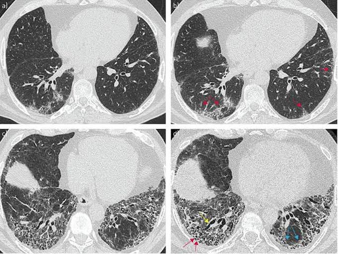 Possible treatment of idiopathic pulmonary fibrosis