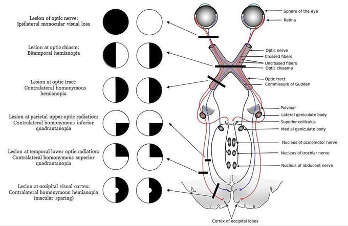 Visual field lesions