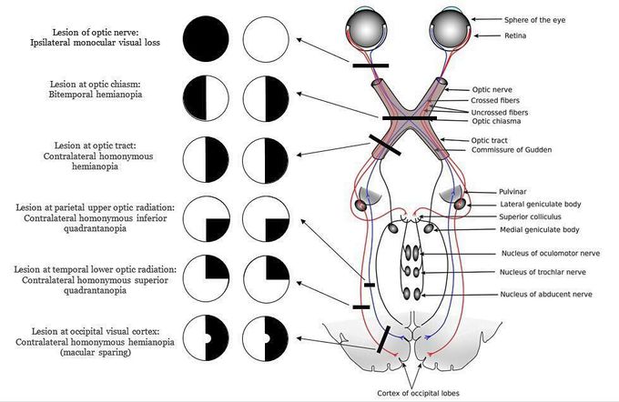 Visual System Lesions Full Article Neurological Visual Field Defects