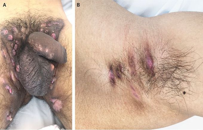 Clinical Diagnosis of Hidradenitis Suppurativa