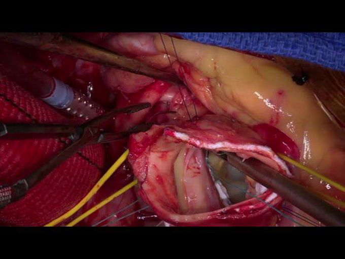 Type A Dissection Repair Using the Florida Sleeve Technique
