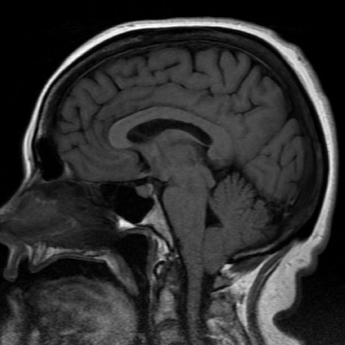 Answer: Chairi Malformation Type 1