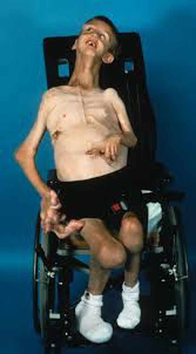 Proteus Syndrome