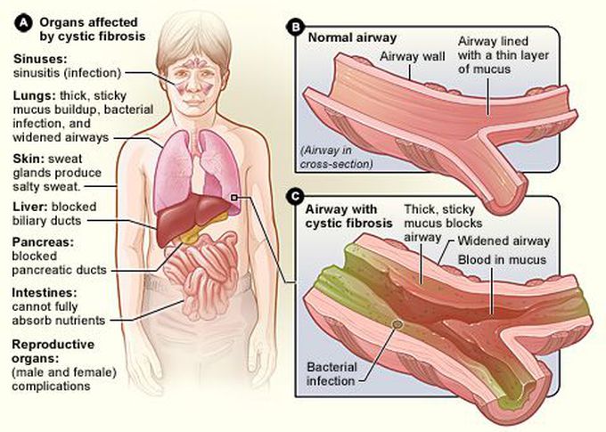 Cystic Fibrosis II