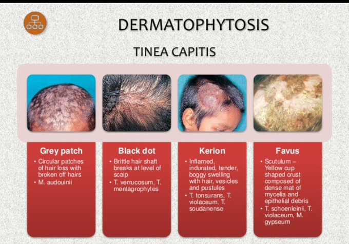 Dermatophytoses