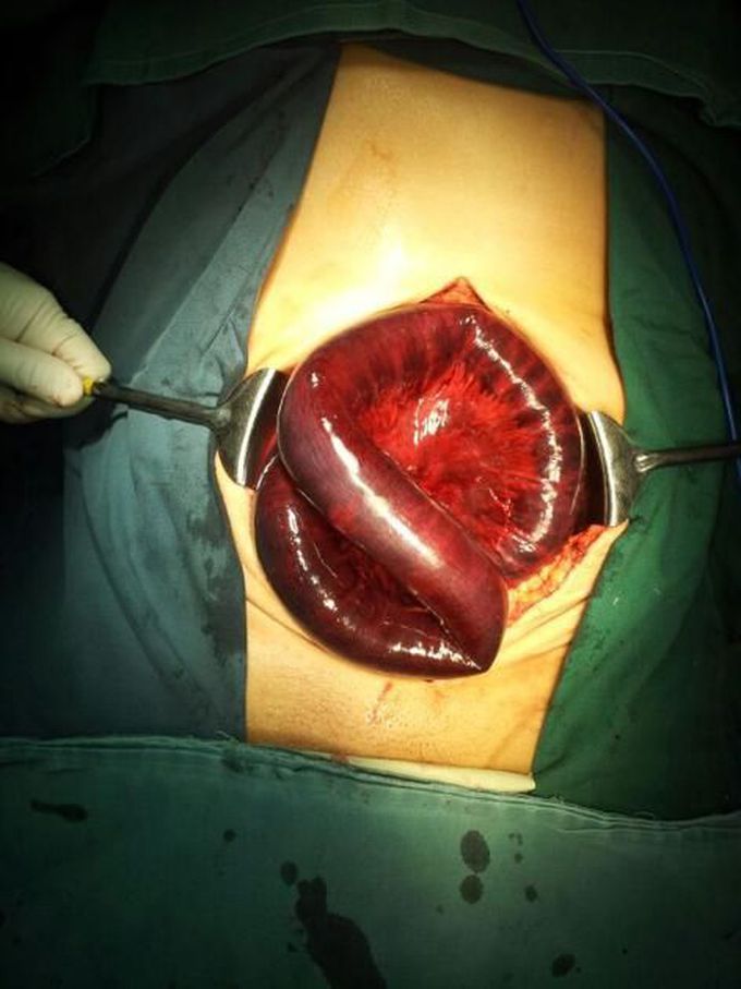 Small bowel ischemia and infarction!