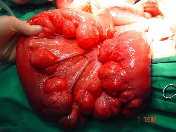 Giant diverticular pouches of the jejunum causing intestinal obstruction.