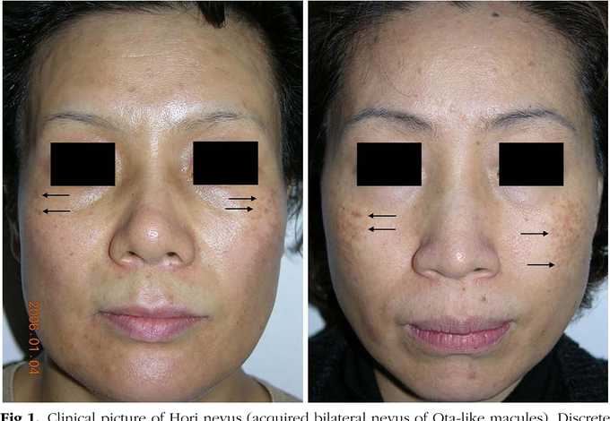 Symptoms of Hori Nevus