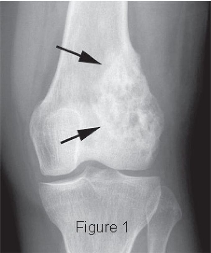 Osteosarcoma