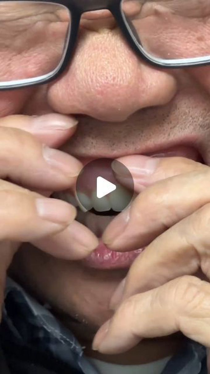 Fitting an upper denture