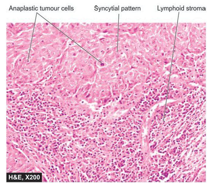 Medullary carcinoma breast