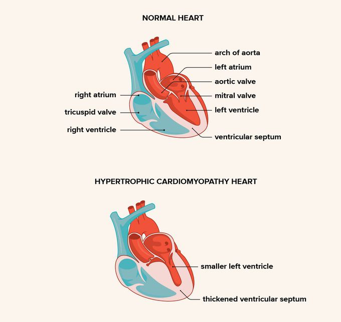 Symptoms of Hypertrophic Cardiomyopathy