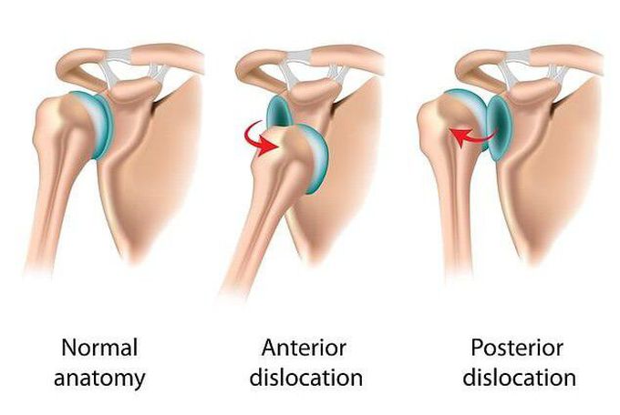 Symptom of Bankart Lesion