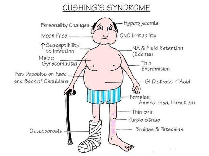 cushing syndrome