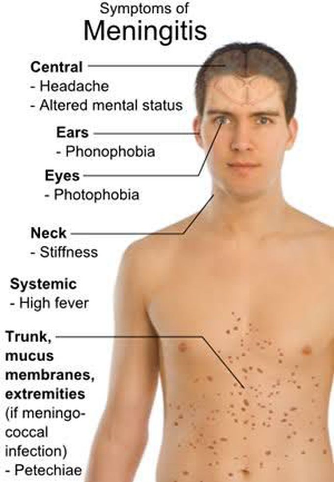 Symptoms of meningitis