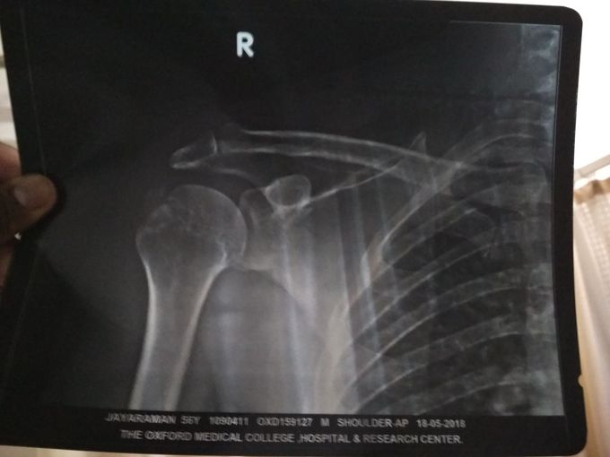 Humerus head fracture