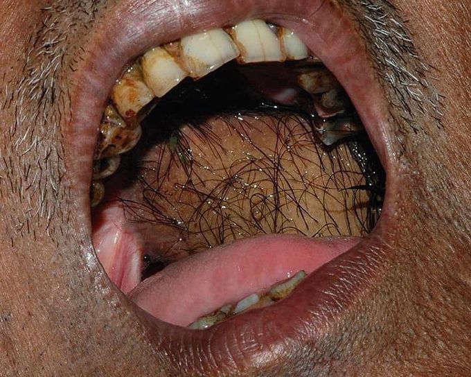 Hairy Intraoral Flaps