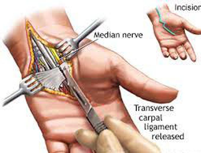 Treatment of carpal tunnel syndrome