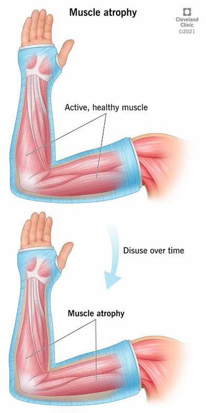 Causes of muscle wasting