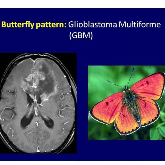 Glioblastoma multiforme