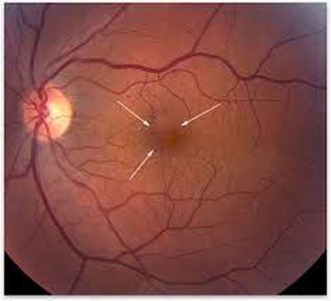 How to treat cystoid macular edema