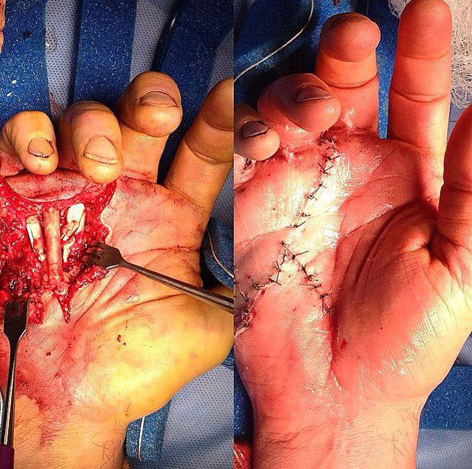 Reconstructive tendon repair hand surgery