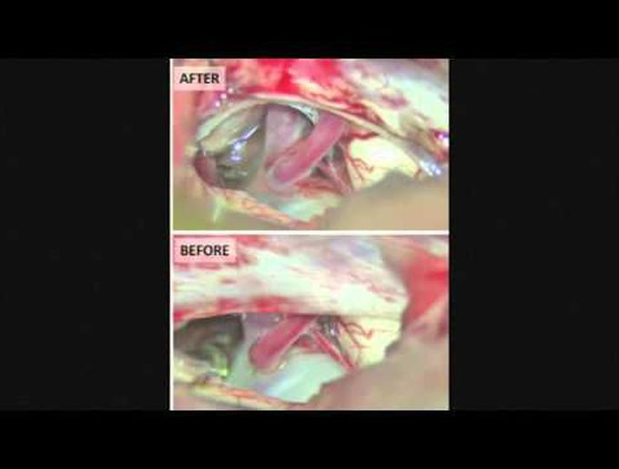 Subtemporal approach for distal basilar occlusion for giant aneurysm