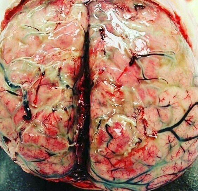 Meningitis