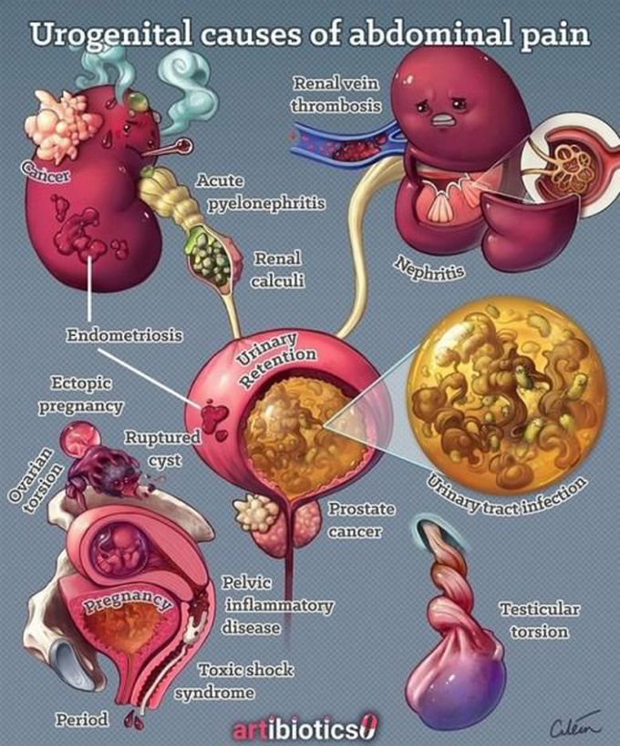 Urogenital causes of abd. Pain