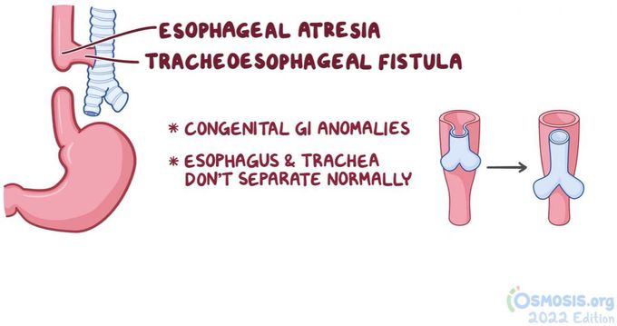 What are the symptoms of tracheoesophageal fistula?