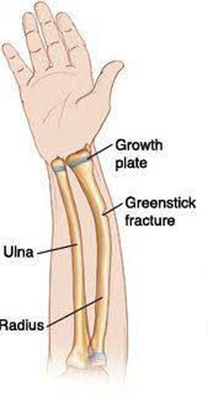 Green Stick Fracture