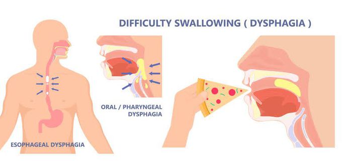 Dysphagia