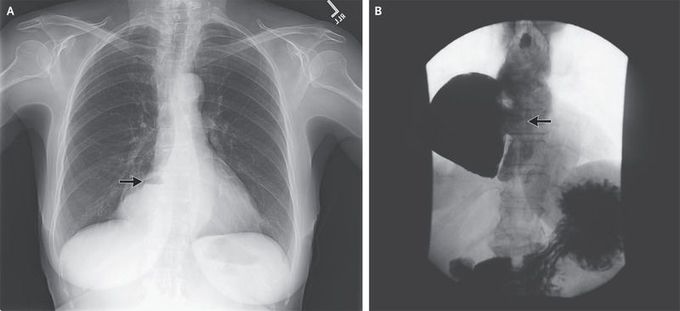Epiphrenic Diverticulum