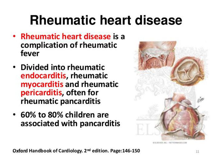 Rhematic Fever >>>>Rheumatic Heart Disease
