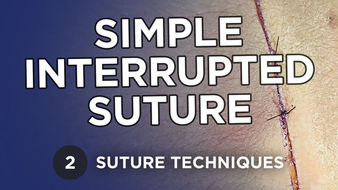 Simple Interrupted Suture
