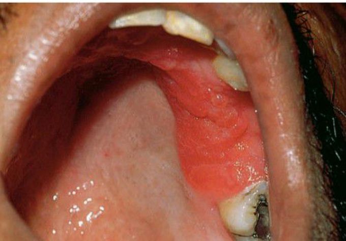 Chronic hyperplastic candidiasis