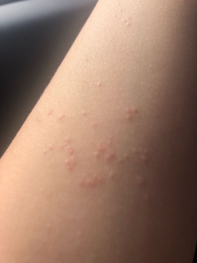 Red point on left arm - MEDizzy