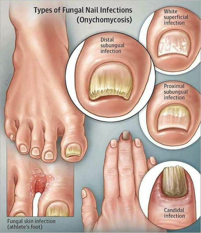 Onychomycosis