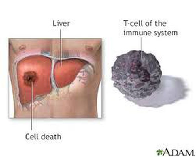 Treatment of amebic liver abcess