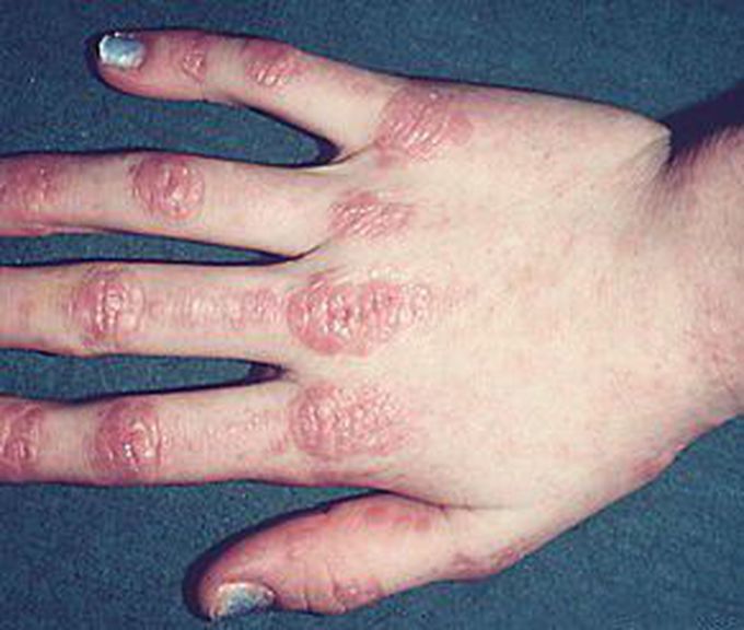 What's the name of this sign in dermatomyositis ??!!