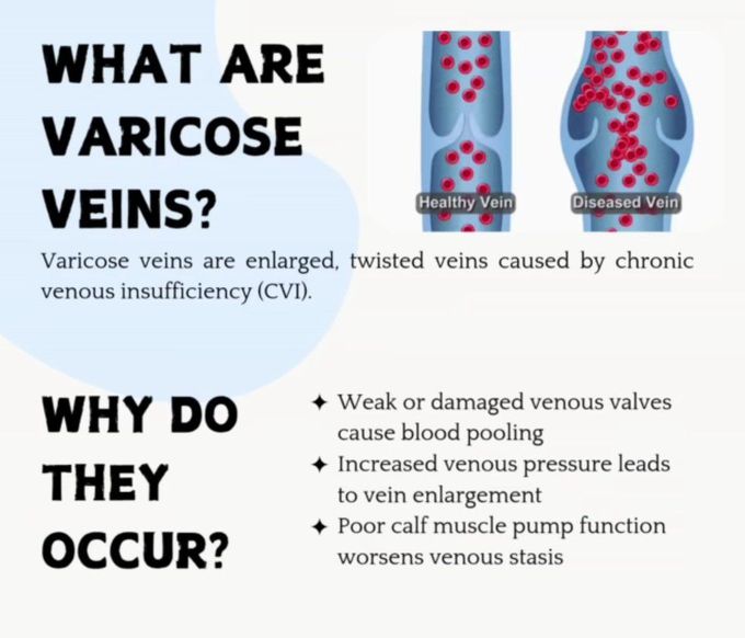 Varicose Veins I