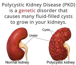 Normal Kidney & Polycystic Kidney - MEDizzy