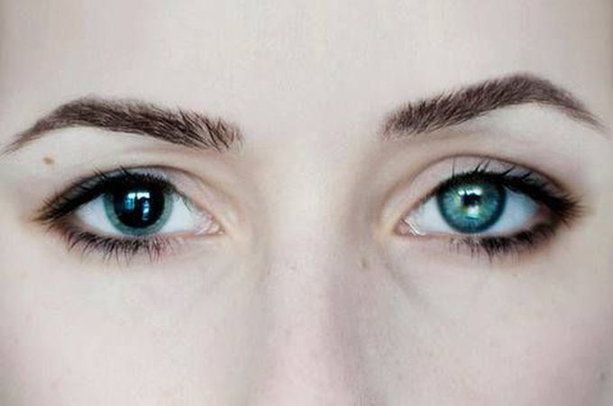 Anisocoria
