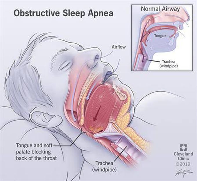 Obstructive Sleep Apnea Medizzy 7008