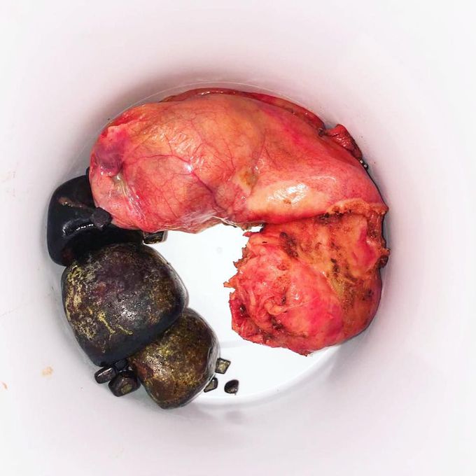 Gallbladder full  of stones 