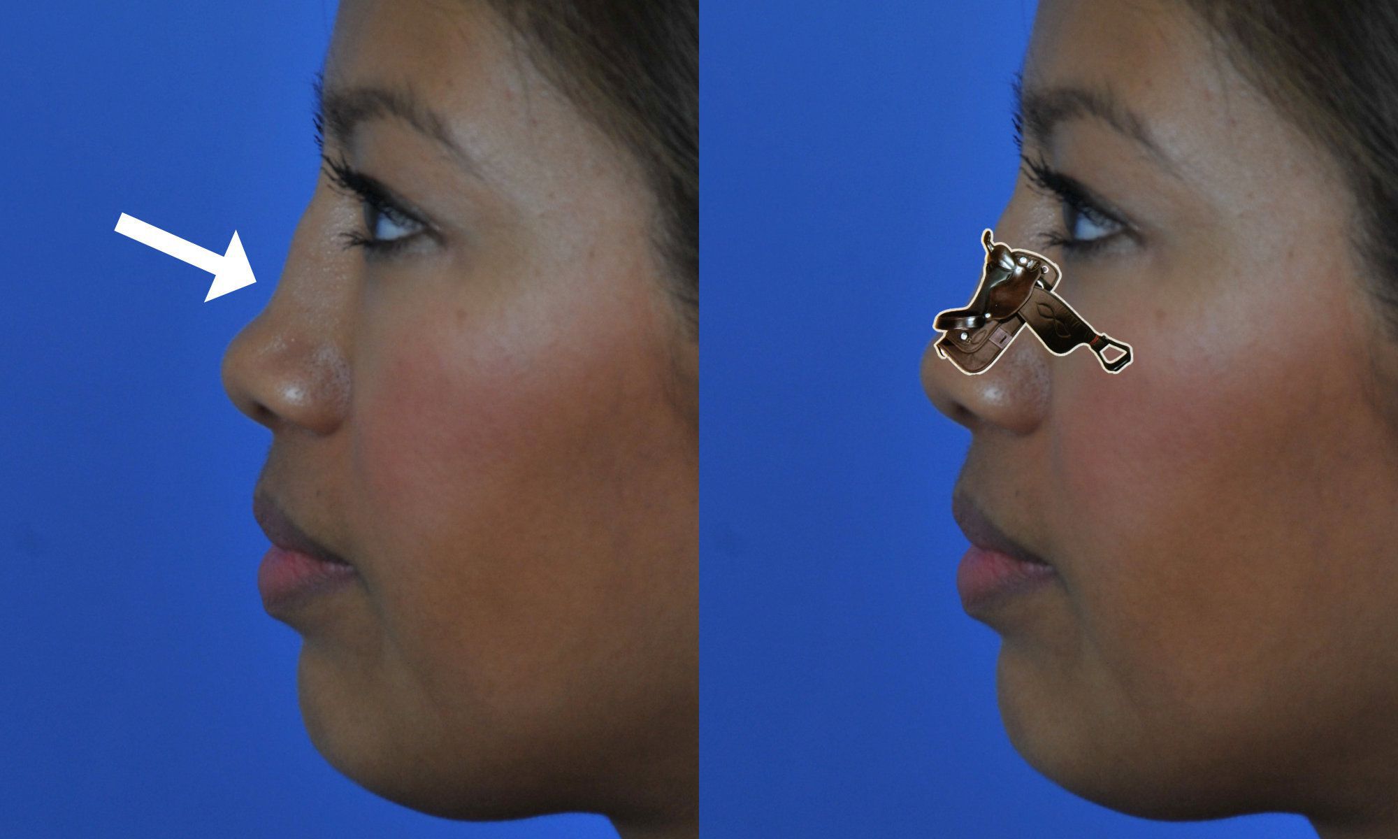 Saddle Nose Deformity MEDizzy