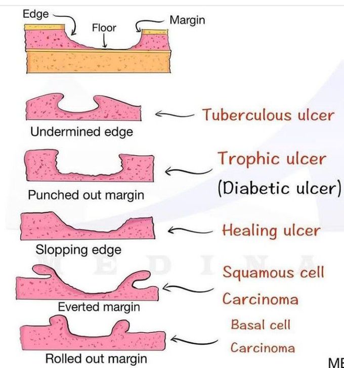 Types of Ulcer Edges