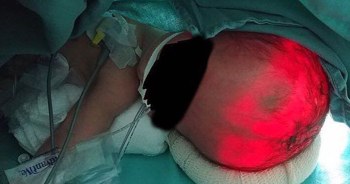 Transillumination of a newborn's head demonstrating hydrocephalus or accumulation of cerebrospinal fluid (CSF) within the brain 